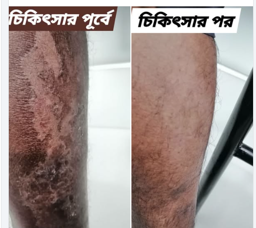 চর্ম রোগের ট্রিটমেন্ট এর আগে ও পরে