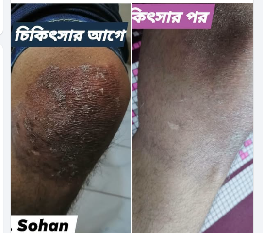 ট্রিটমেন্ট এর আগে ও পরে