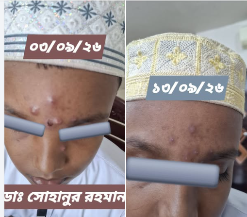 ট্রিটমেন্ট এর আগে ও পরে